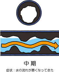 中期 症状：水の流れが悪くなってきた